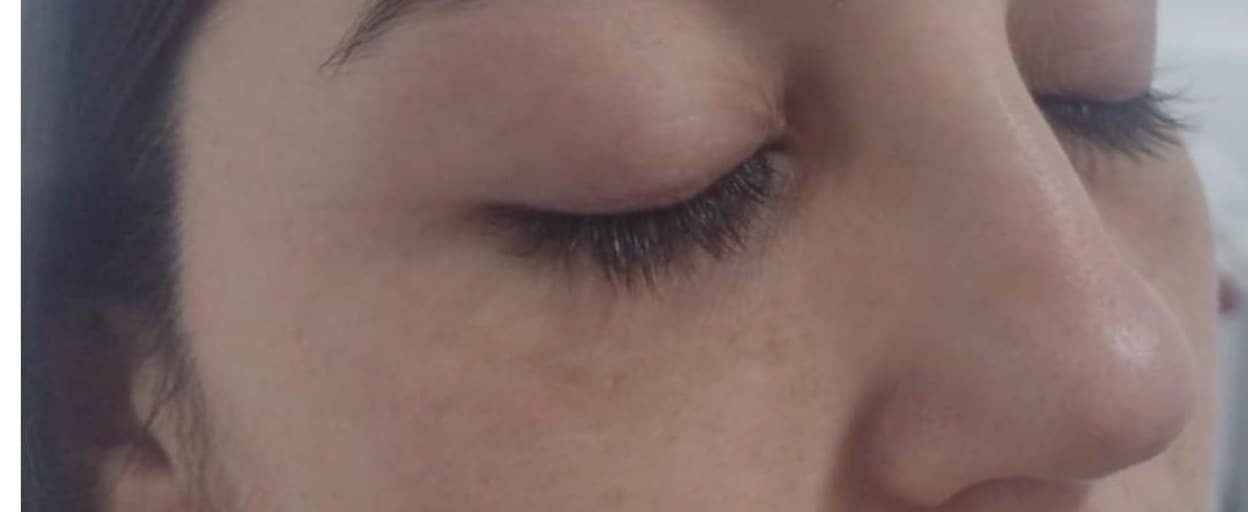 Contorno de ojos después del tratamiento con exosomas AGF