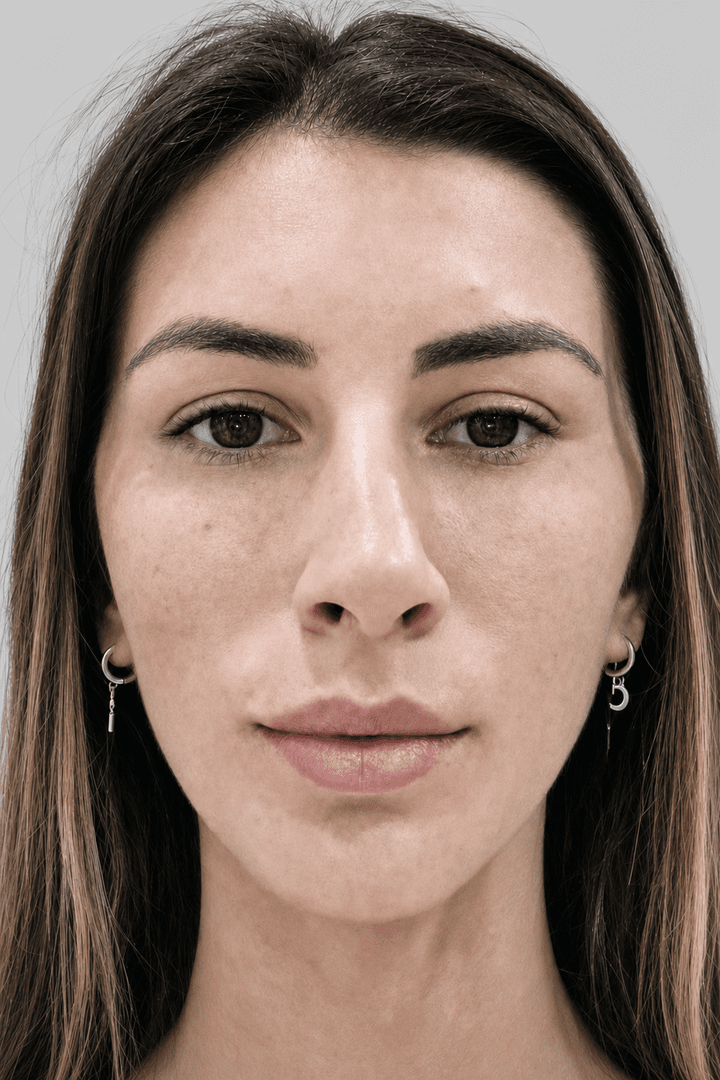 Misma paciente después del tratamiento con hilos tensores — óvalo facial y línea mandibular más definidos — A-Estheticnet