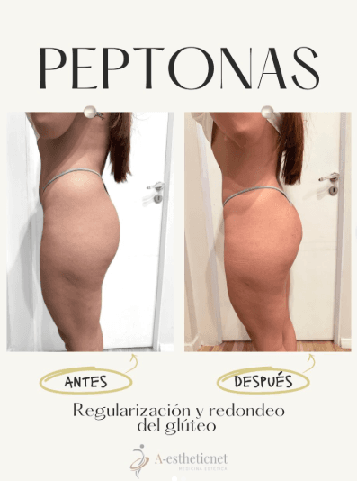 Peptonas - regularización y redondeo del glúteo